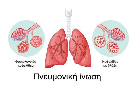 Η Περιφέρεια Κρήτης συμμετέχει και στηρίζει την εκστρατεία ενημέρωσης για την Πευμονική Ίνωση-Φωταγωγείται αύριο Τετάρτη το κτίριο της στην πλ. Ελευθερίας